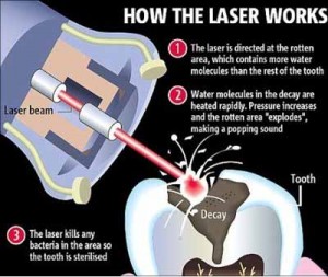 laser-decay