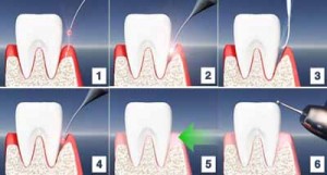 laser-dent-surgery